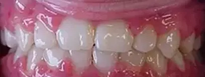 Cool Smiles Orthodontics - After Treatment