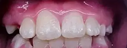 Cool Smiles Orthodontics - After Treatment