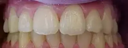 Cool Smiles Orthodontics - After Treatment