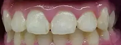 Cool Smiles Orthodontics - After Treatment
