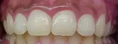Cool Smiles Orthodontics - After Treatment