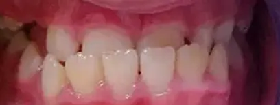 Cool Smiles Orthodontics - Before Treatment