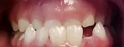 Cool Smiles Orthodontics - Before Treatment