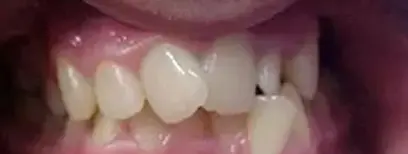 Cool Smiles Orthodontics - Before Treatment
