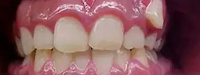 Cool Smiles Orthodontics - Before Treatment