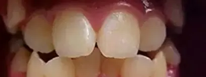 Cool Smiles Orthodontics - Before Treatment