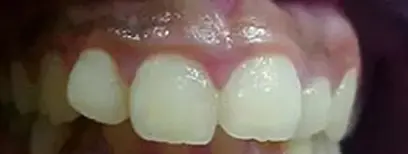 Cool Smiles Orthodontics - Before Treatment