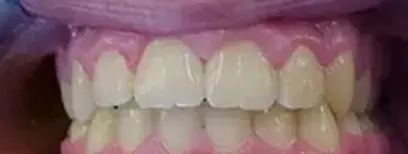 Cool Smiles Orthodontics - After Treatment