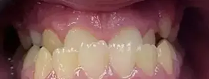 Cool Smiles Orthodontics - Before Treatment