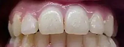 Cool Smiles Orthodontics - After Treatment