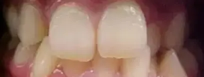 Cool Smiles Orthodontics - Before Treatment