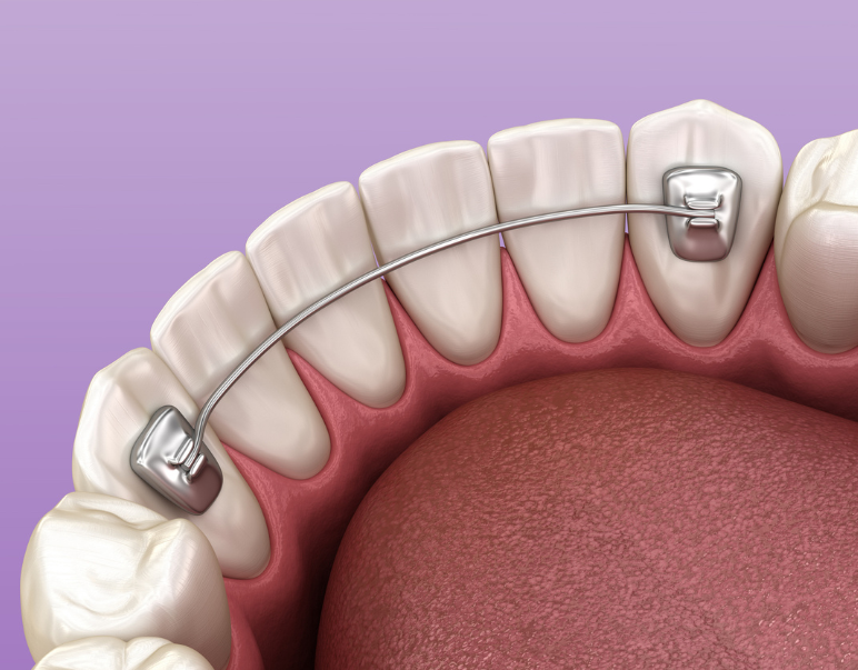 Retainers dental installed after braces treatment, Medically accurate dental 3D illustration
