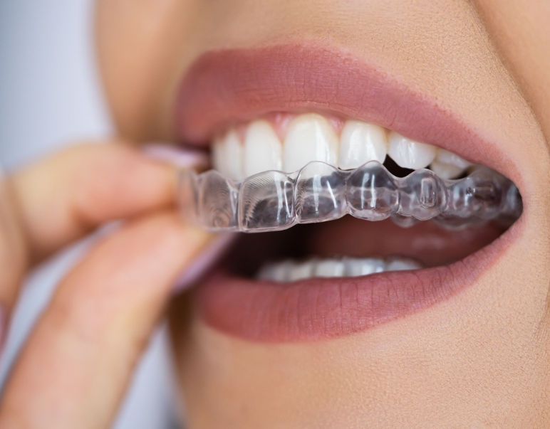 A close-up image of a person inserting a clear dental aligner over their teeth, showing well-aligned white teeth and natural lip color, conveying dental care.