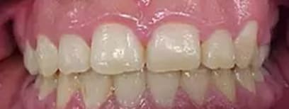 Cool Smiles Orthodontics - After Treatment