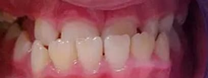 Cool Smiles Orthodontics - Before Treatment