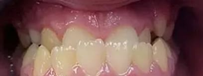 Cool Smiles Orthodontics - Before Treatment